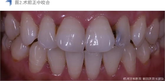 Vitique瓷贴面粘接系统的临床应用