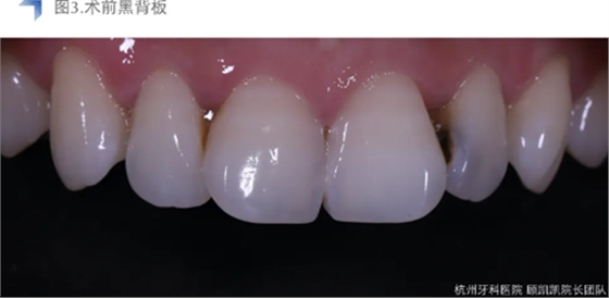 Vitique瓷贴面粘接系统的临床应用