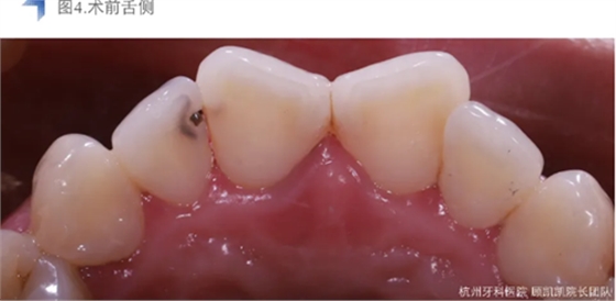 Vitique瓷贴面粘接系统的临床应用