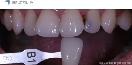 Vitique瓷贴面粘接系统的临床应用