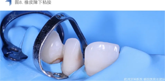 Vitique瓷贴面粘接系统的临床应用