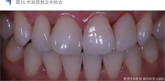 Vitique瓷贴面粘接系统的临床应用