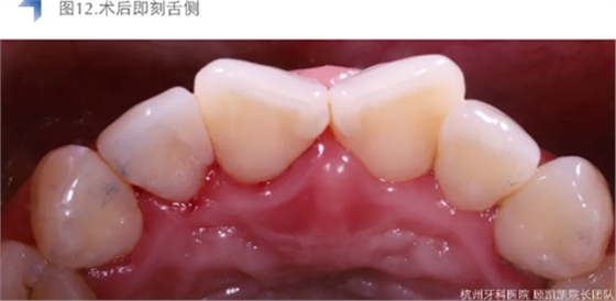 Vitique瓷贴面粘接系统的临床应用