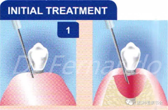 种植体周围炎的软硬组织重建治疗(下)
