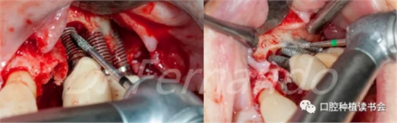 种植体周围炎的软硬组织重建治疗(下)