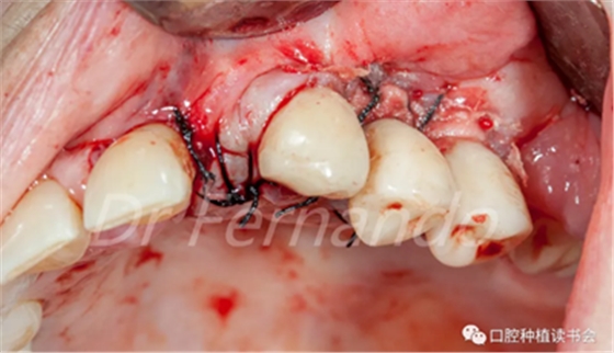 种植体周围炎的软硬组织重建治疗(下)