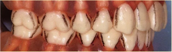 牙周袋深度测定法 牙周袋深度测定法