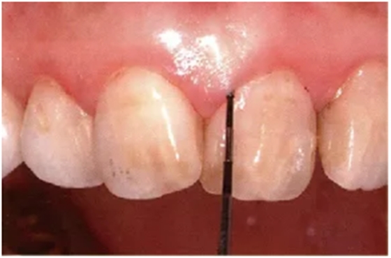 牙周袋深度测定法 牙周袋深度测定法