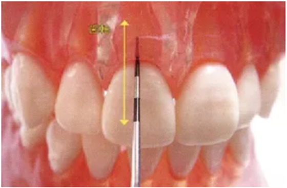 牙周袋深度测定法 牙周袋深度测定法