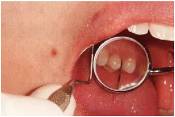 牙周袋深度测定法 牙周袋深度测定法