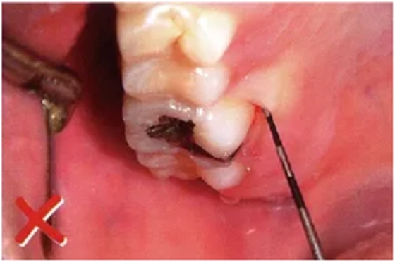 牙周袋深度测定法 牙周袋深度测定法