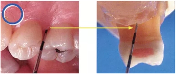 牙周袋深度测定法 牙周袋深度测定法