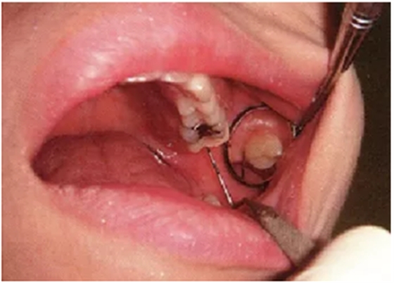 牙周袋深度测定法 牙周袋深度测定法