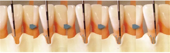 牙周袋深度测定法 牙周袋深度测定法