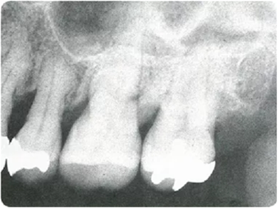 牙周袋深度测定法 牙周袋深度测定法