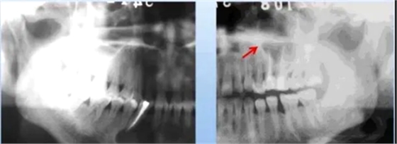 各类根尖周病的X片表现