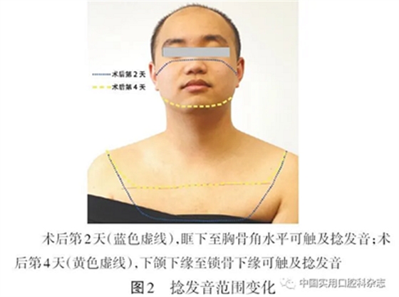 病例报告 | 下颌第三磨牙拔除术后并发双侧广泛性皮下气肿及纵隔气肿1例报告