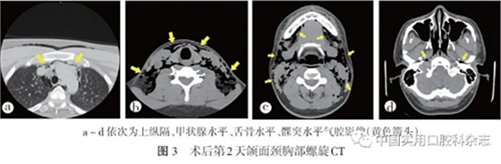 病例报告 | 下颌第三磨牙拔除术后并发双侧广泛性皮下气肿及纵隔气肿1例报告