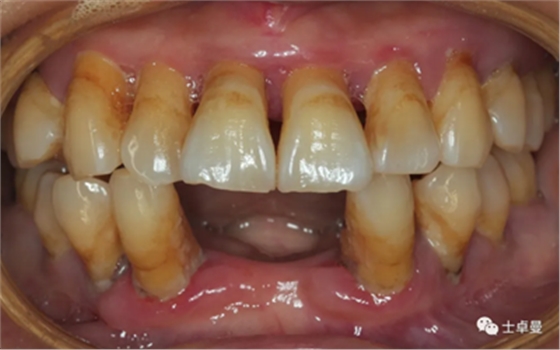【病例分享】应用全程数字化对牙周炎患者实现全口即刻种植即刻修复