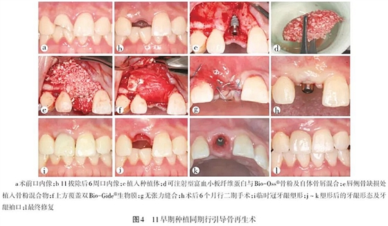  前牙美学区种植时机的选择