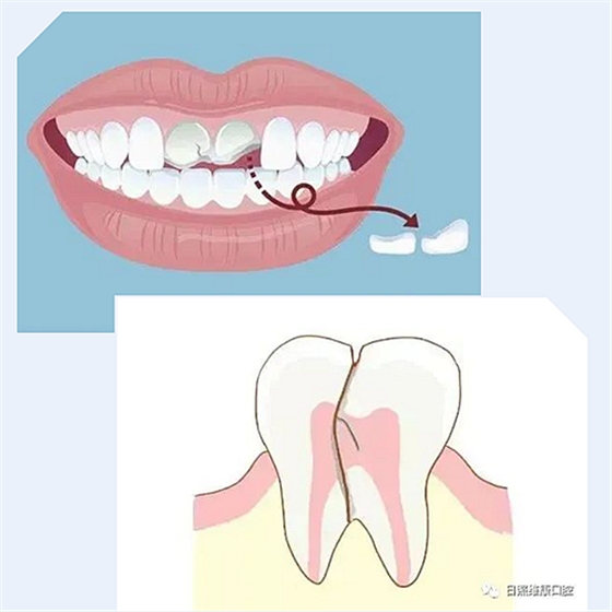 口腔科普 | 残根残冠怎么办——桩核冠