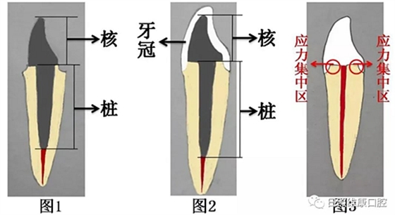 口腔科普 | 残根残冠怎么办——桩核冠