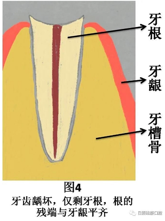 口腔科普 | 残根残冠怎么办——桩核冠