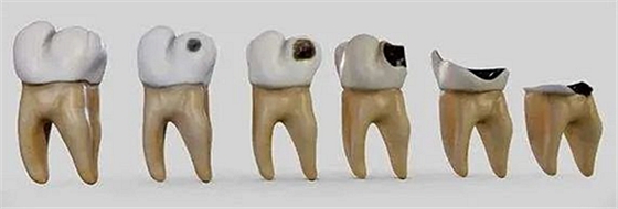 妙手牙医丨残根、残冠还有保留的意义吗？