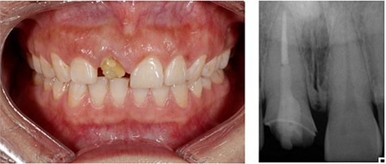 妙手牙医丨残根、残冠还有保留的意义吗？