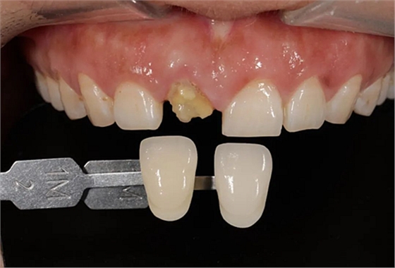 妙手牙医丨残根、残冠还有保留的意义吗？