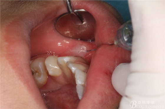 微创法摘除下颌第二前磨牙含牙囊肿