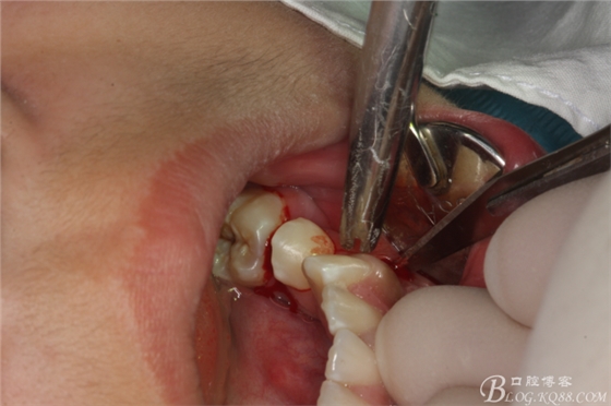 微创法摘除下颌第二前磨牙含牙囊肿