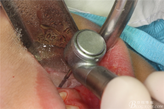 微创法摘除下颌第二前磨牙含牙囊肿