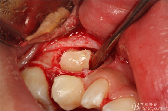 微创法摘除下颌第二前磨牙含牙囊肿