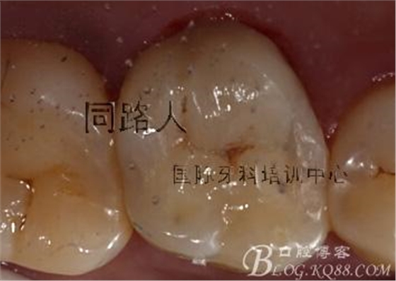 树脂嵌体制作的阶段性总结