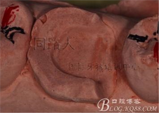 树脂嵌体制作的阶段性总结
