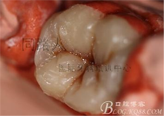 树脂嵌体制作的阶段性总结