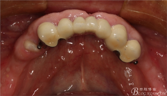重度牙周炎的咬合重建修复两年后效果－－塘沽牙医吴世超