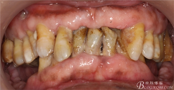 重度牙周炎的咬合重建修复两年后效果－－塘沽牙医吴世超