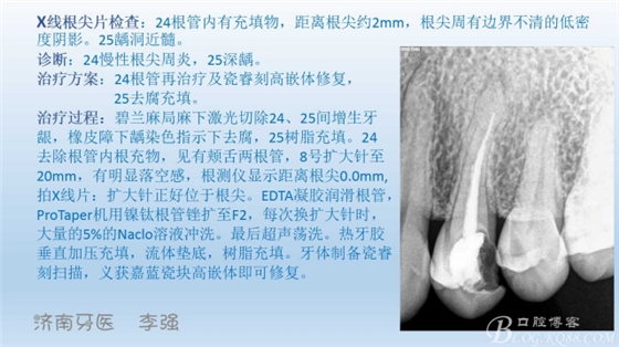 根管再治疗，高嵌体即可修复（济南牙医~ 李强）