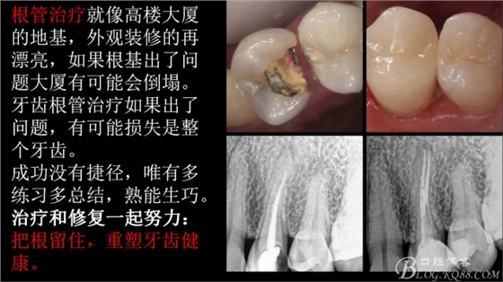 根管再治疗，高嵌体即可修复（济南牙医~ 李强）