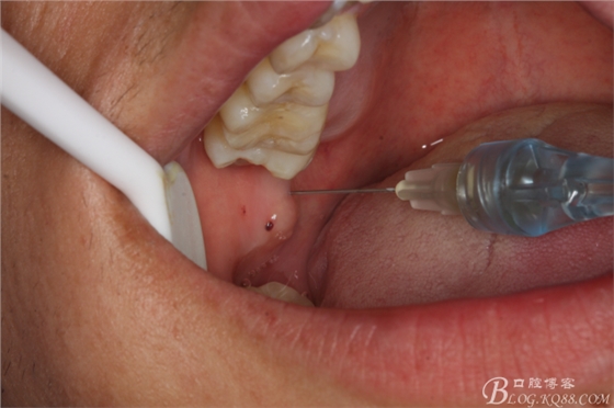 双侧下颌第二磨牙阻生牙的微创拔除