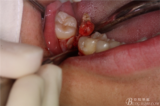 双侧下颌第二磨牙阻生牙的微创拔除