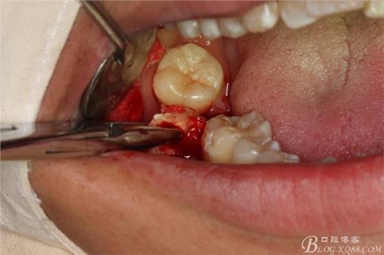 双侧下颌第二磨牙阻生牙的微创拔除