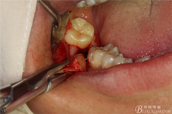双侧下颌第二磨牙阻生牙的微创拔除