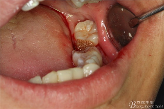 双侧下颌第二磨牙阻生牙的微创拔除