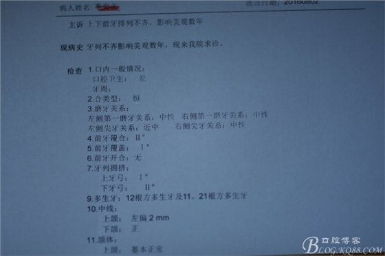 双切口拔除鼻底埋伏多生牙