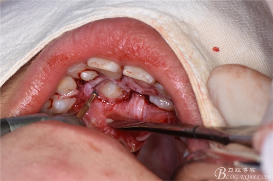 腭侧开窗牵引双侧埋伏尖牙
