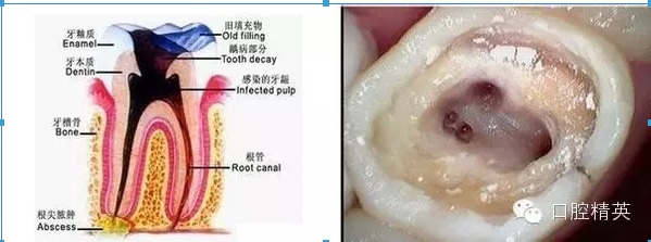 根管治疗中开放的危害