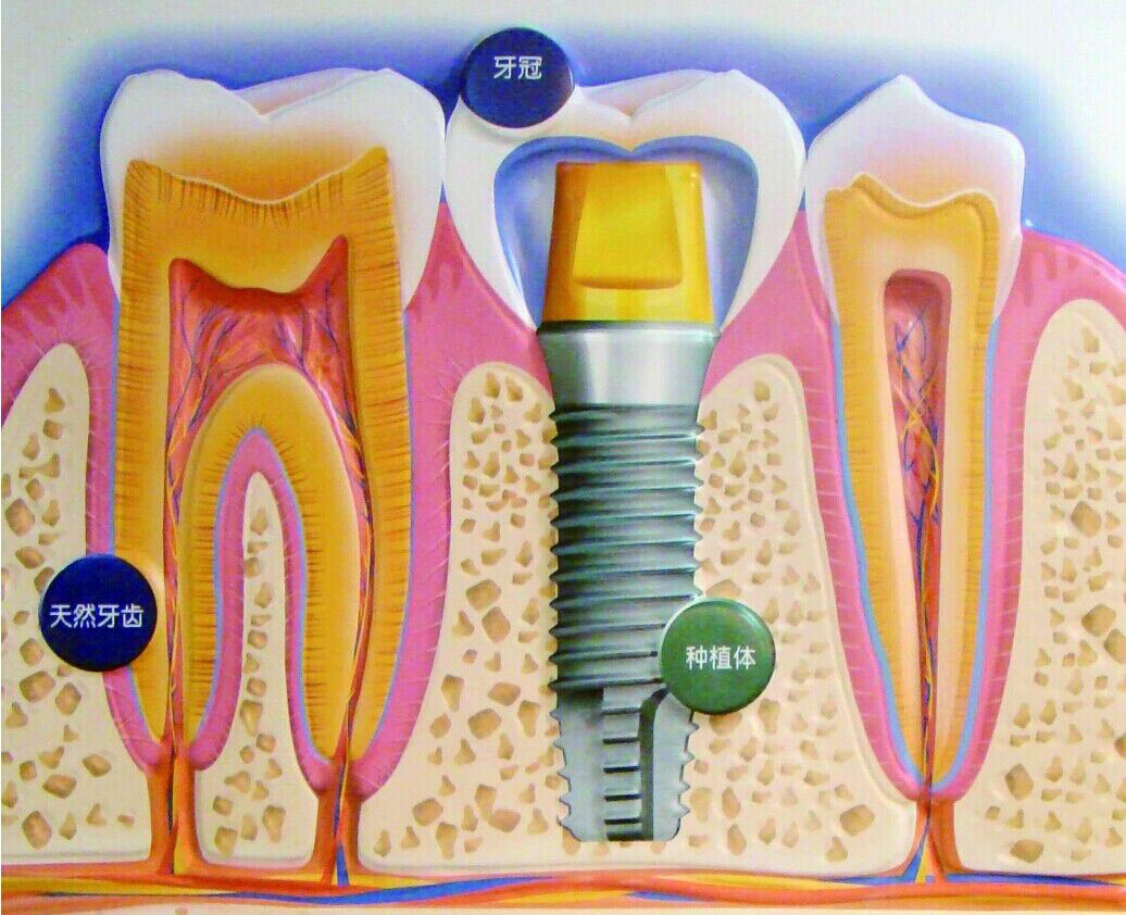 种植牙究竟能用多久？_厦门口腔医院_厦门麦芽口腔医院【官方网站】